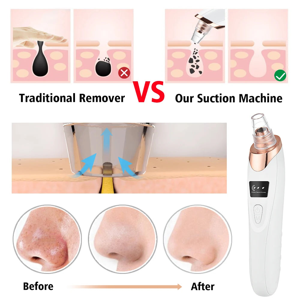 3 Suction Mode Blackhead Remover-Face Cleansing Beauty Machine Dead Skin Remover + Skin Care Tool