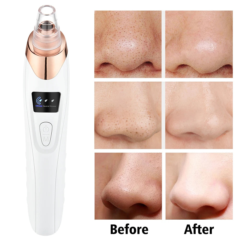 3 Suction Mode Blackhead Remover-Face Cleansing Beauty Machine Dead Skin Remover + Skin Care Tool